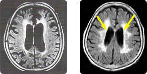 치매걸린뇌의 CT사진입니다.