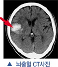 뇌출혈 CT사진