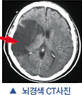 뇌경색 CT사진